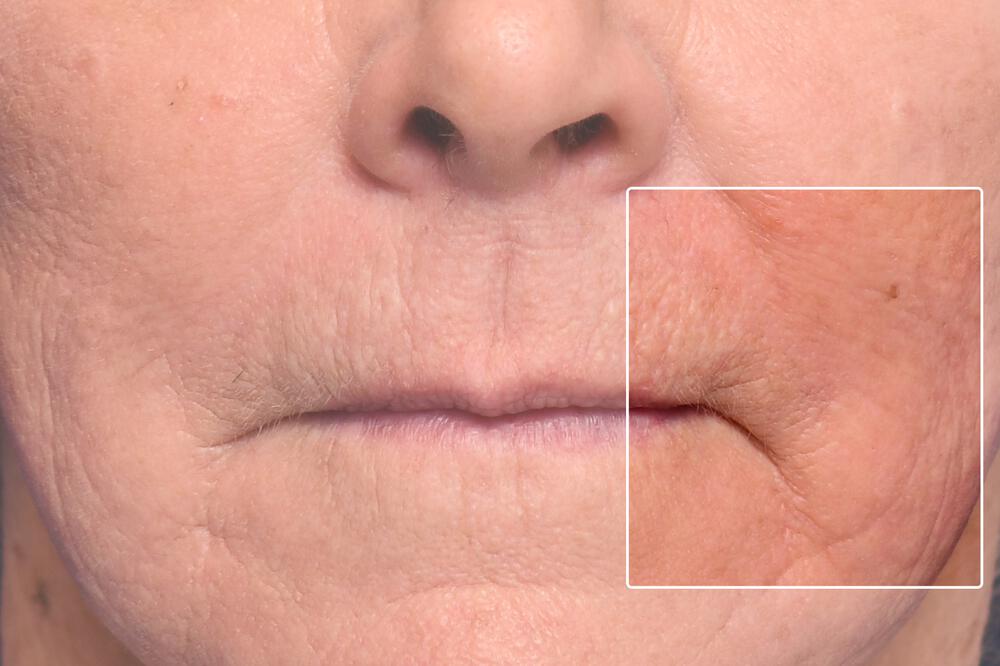 ProFractional Laser Before & After Image