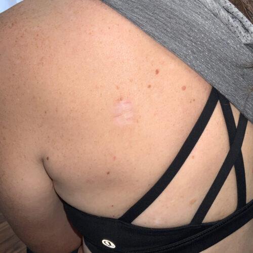 Scar Treatment Before & After Image