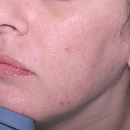 Scar Treatment Before & After Image