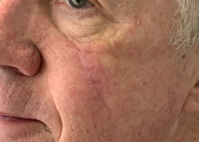 Scar Treatment Before & After Image