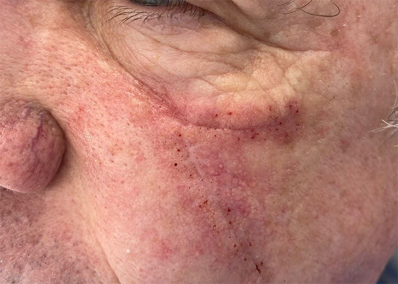 Scar Treatment Before & After Image