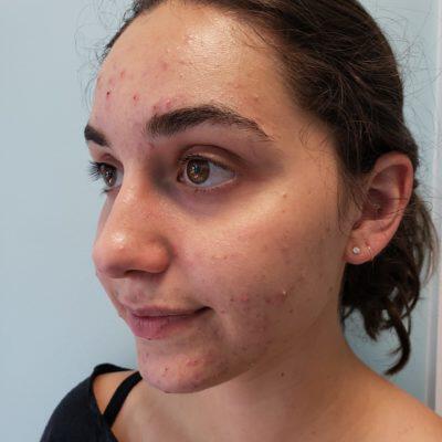 Acne Treatment Before & After Image